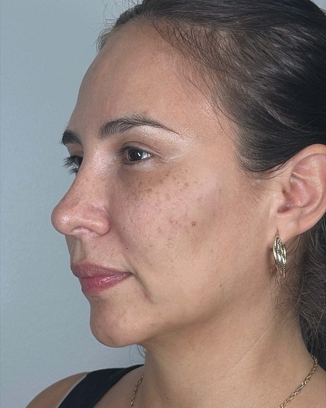 Juvederm Before & After