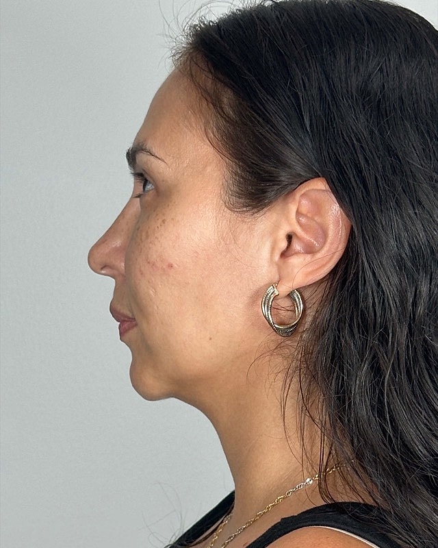 Juvederm Before & After
