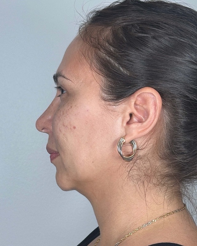 Juvederm Before & After