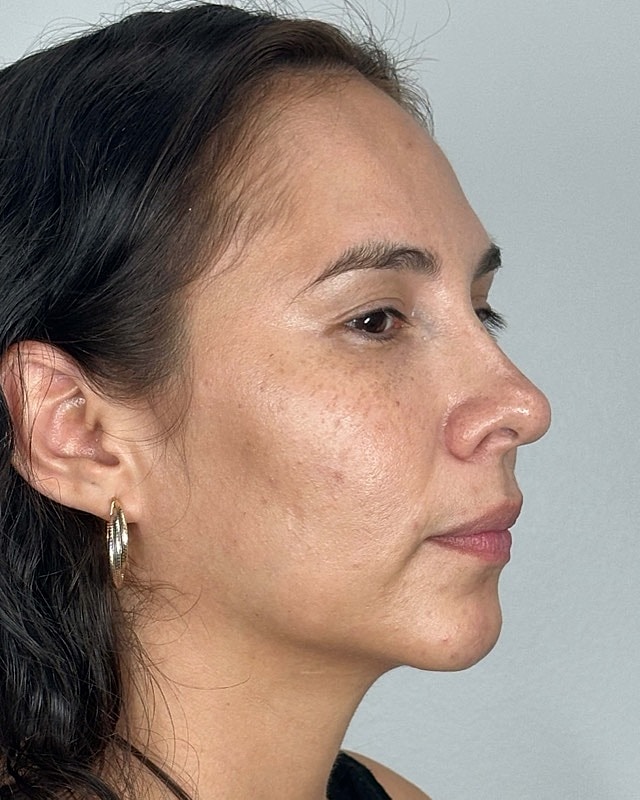 Juvederm Before & After