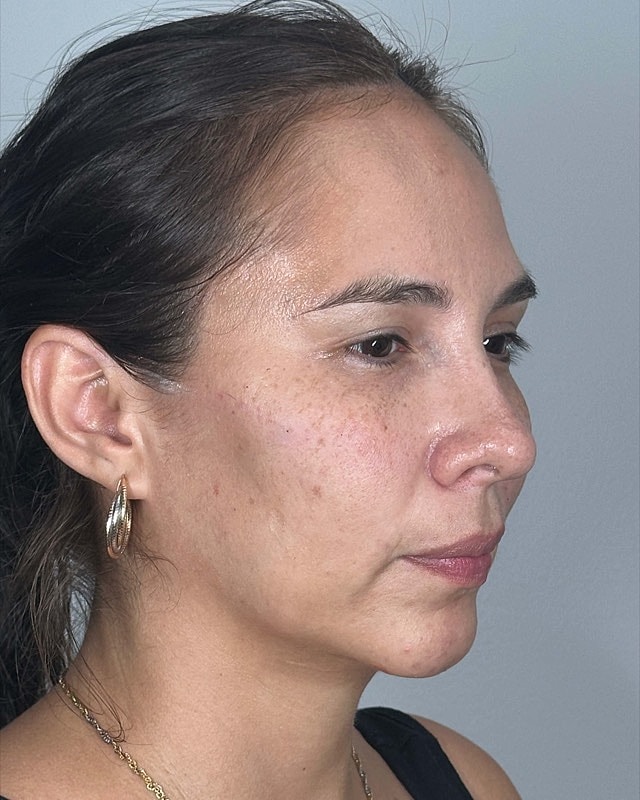 Juvederm Before & After