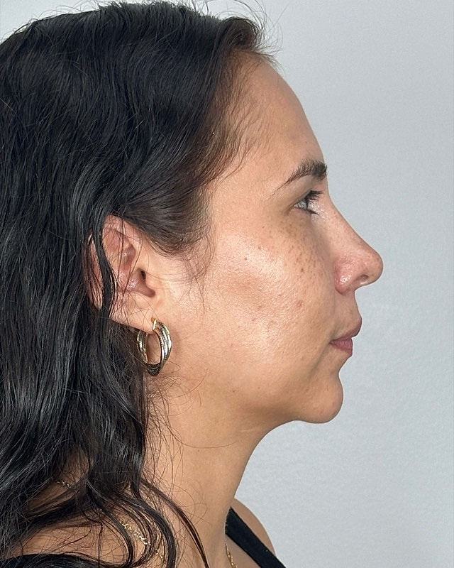 Juvederm Before & After