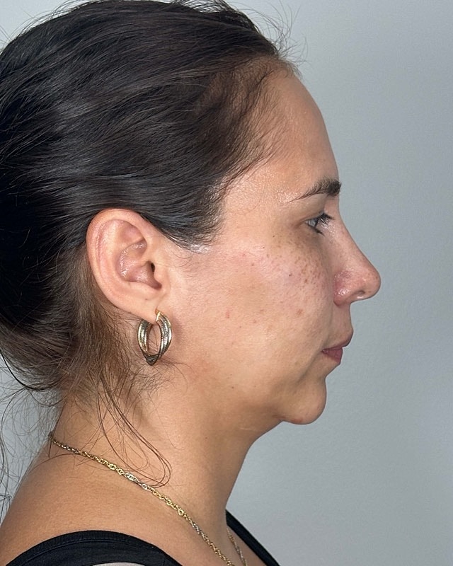 Juvederm Before & After