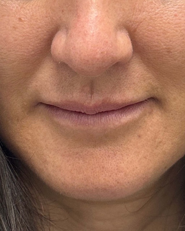 Juvederm Before & After