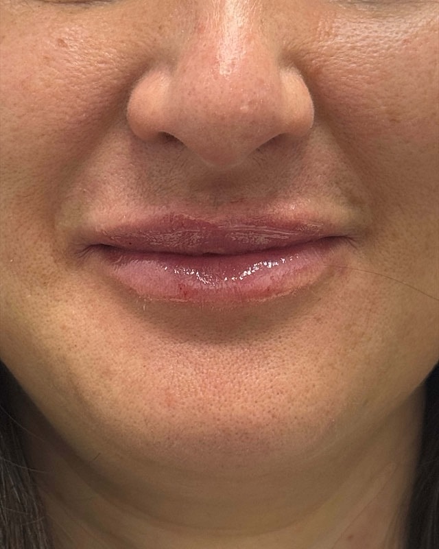 Juvederm Before & After