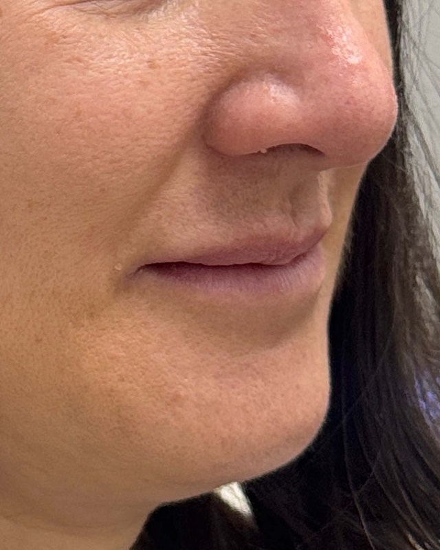 Juvederm Before & After
