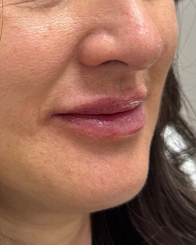 Juvederm Before & After