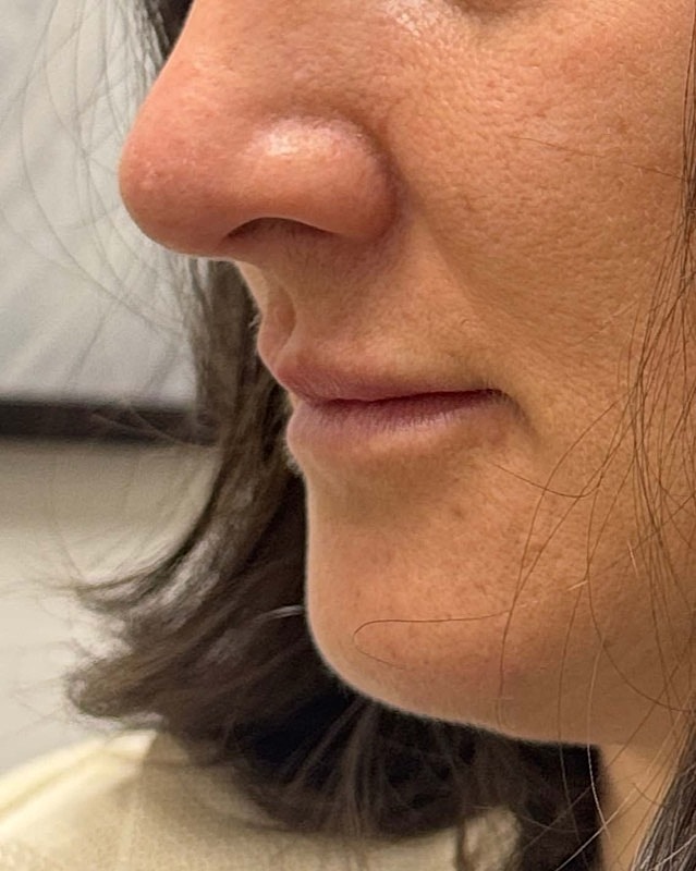 Juvederm Before & After