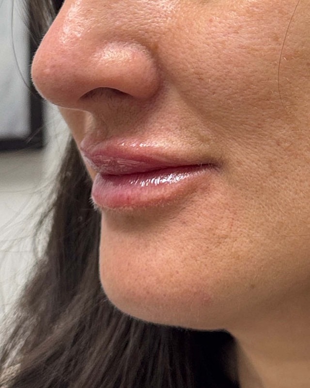 Juvederm Before & After