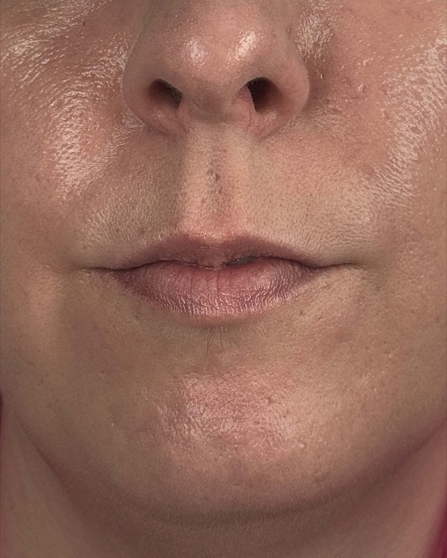 Juvederm Before & After
