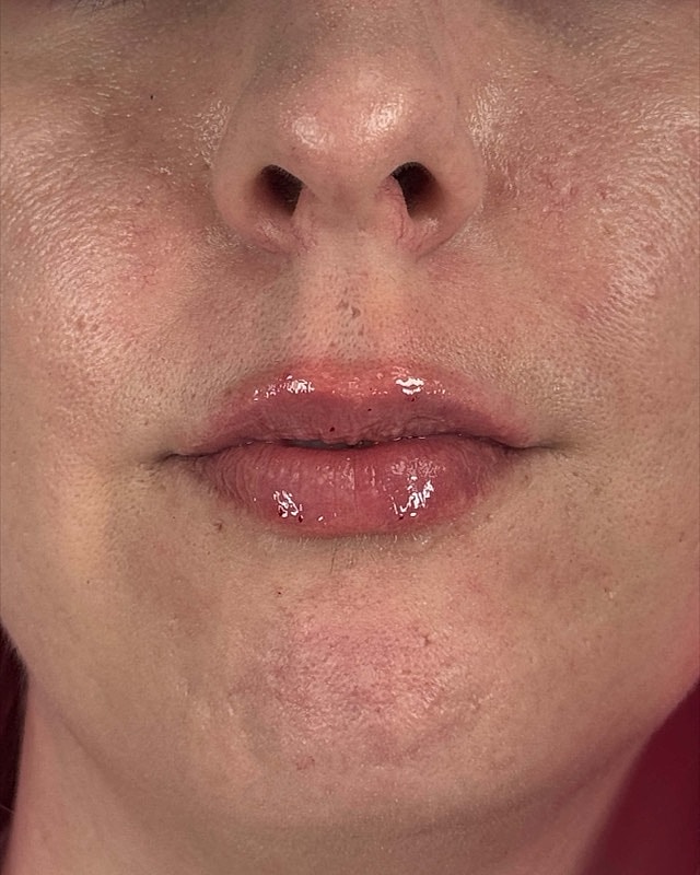 Juvederm Before & After