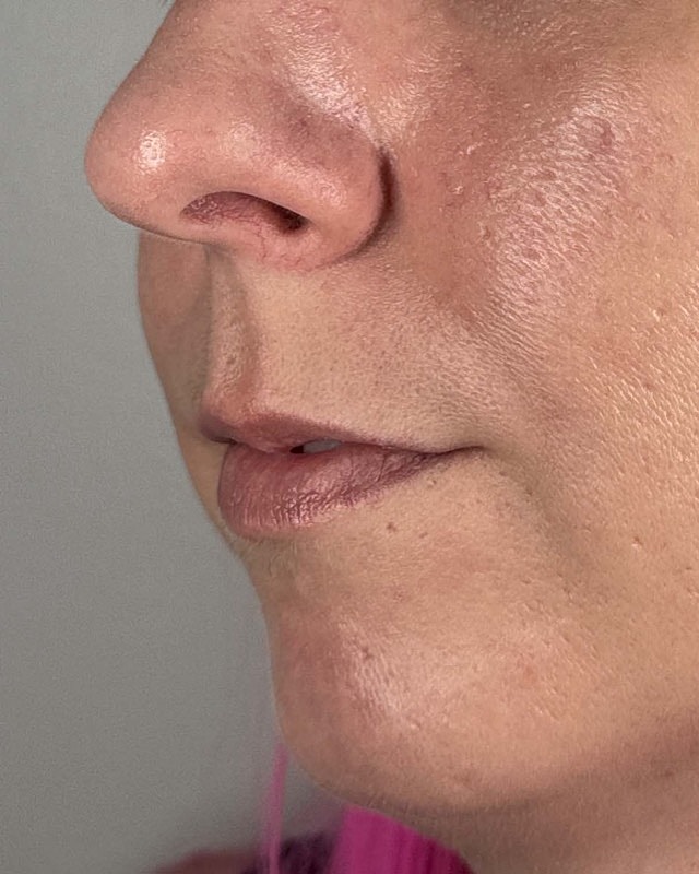 Juvederm Before & After