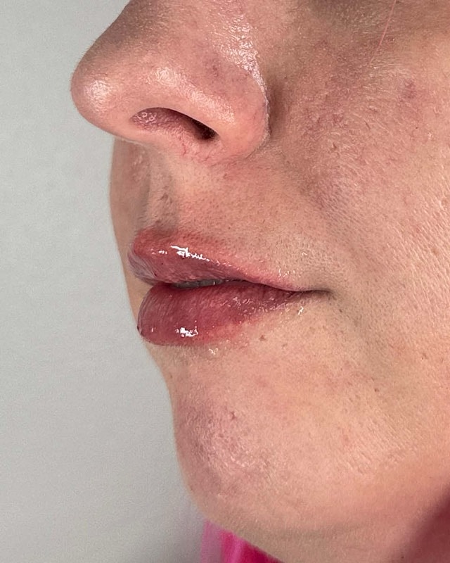Juvederm Before & After