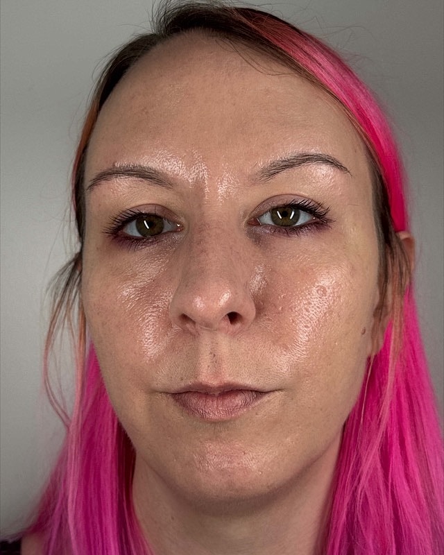 Juvederm Before & After