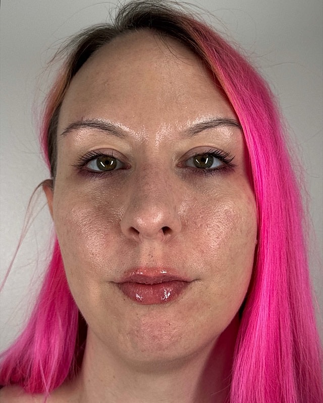 Juvederm Before & After