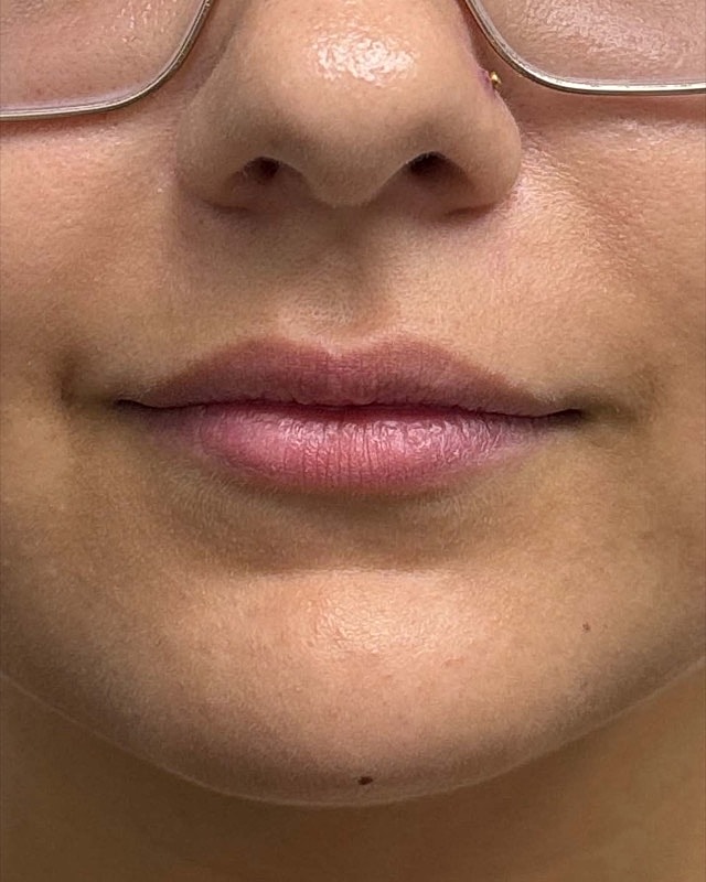Juvederm Before & After
