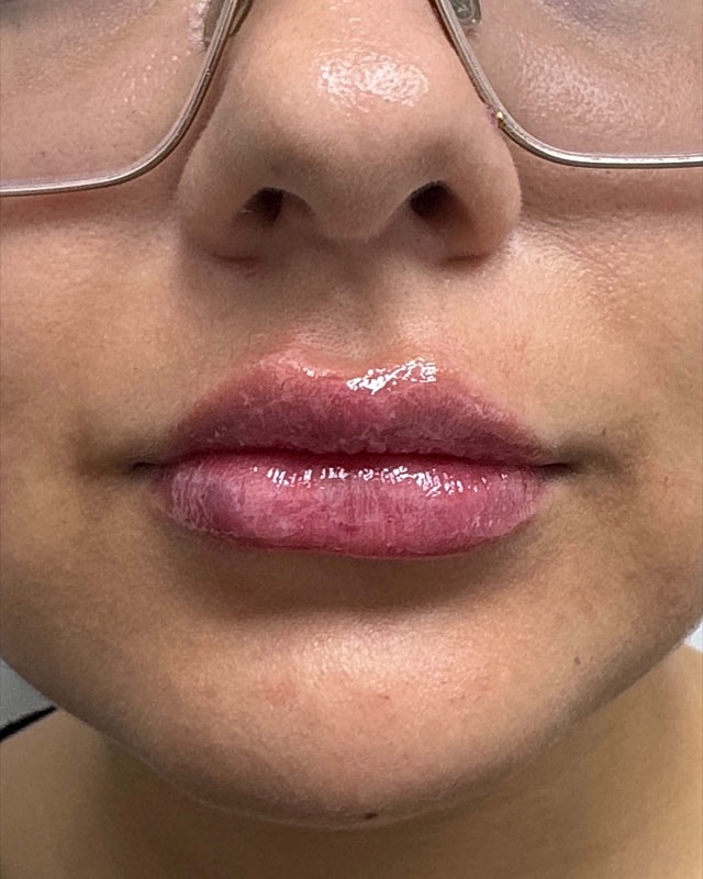 Juvederm Before & After