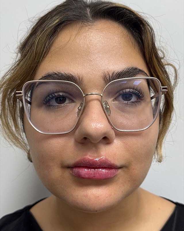 Juvederm Before & After