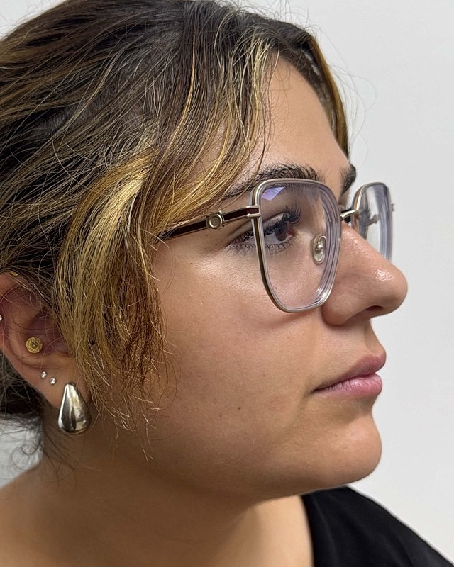 Juvederm Before & After