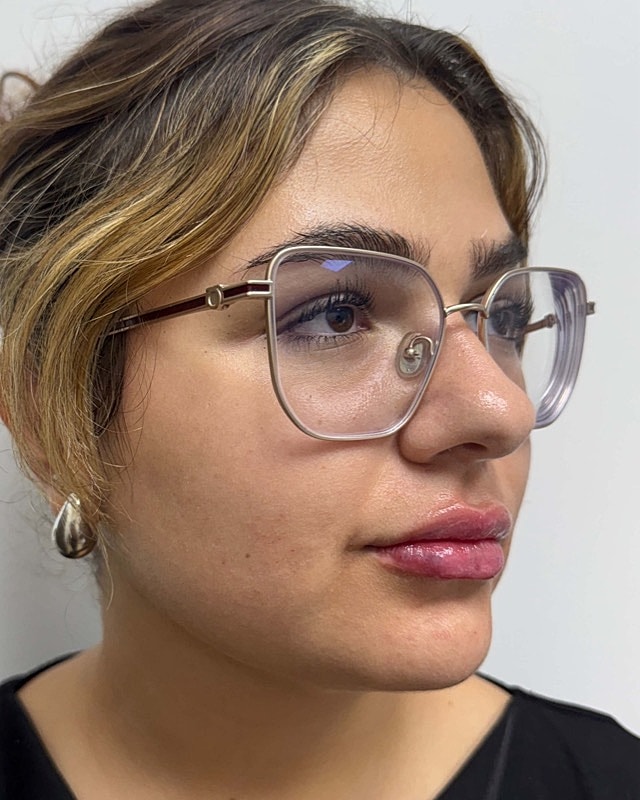 Juvederm Before & After