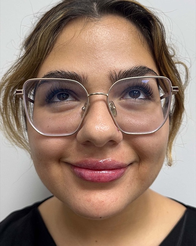Juvederm Before & After