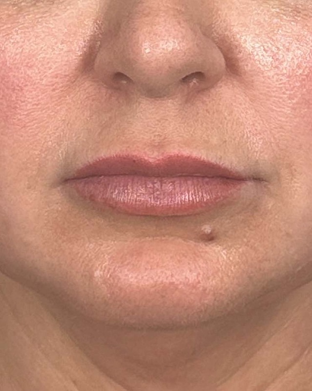 Juvederm Before & After