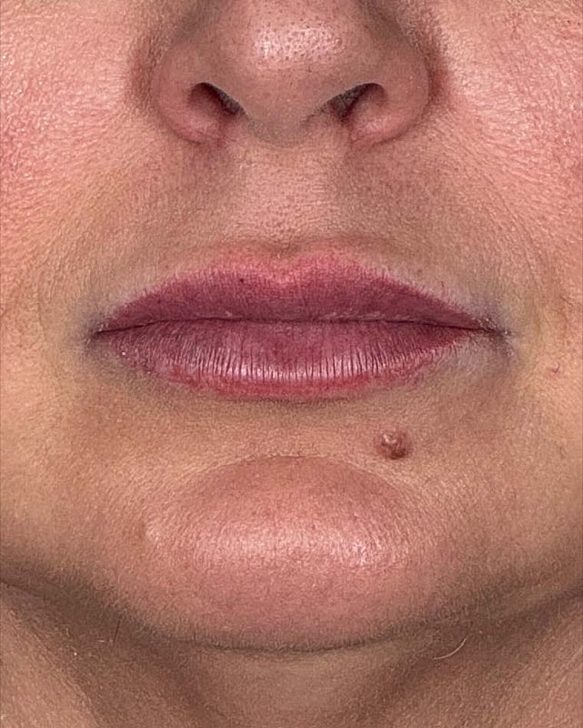 Juvederm Before & After