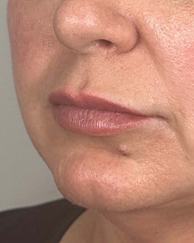 Juvederm Before & After