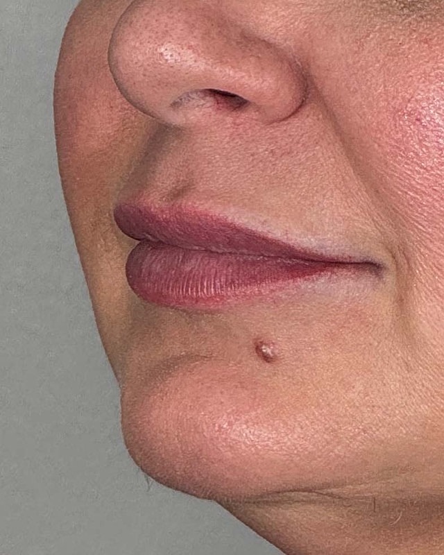 Juvederm Before & After