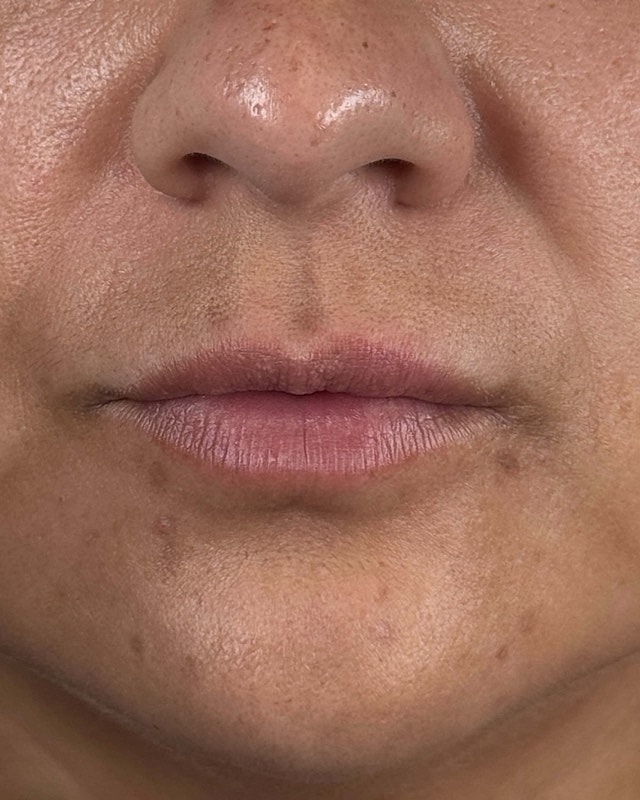 Juvederm Before & After