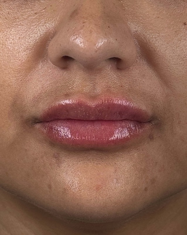 Juvederm Before & After