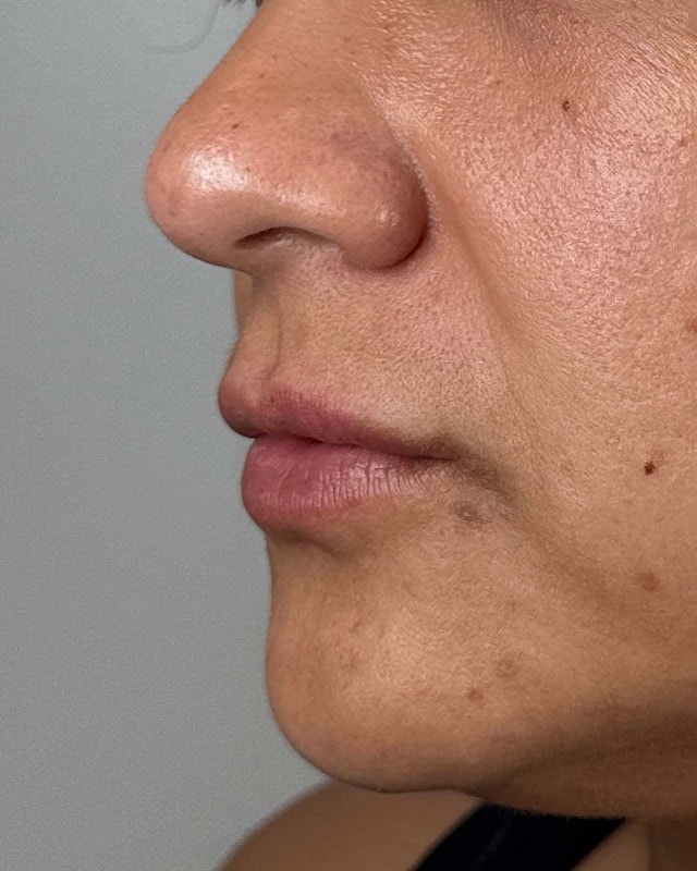 Juvederm Before & After