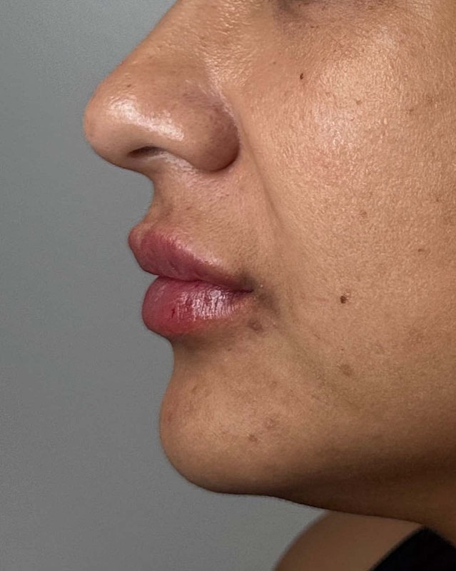 Juvederm Before & After