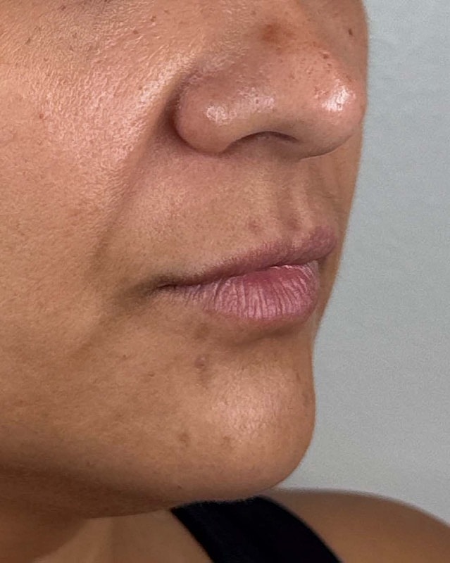 Juvederm Before & After