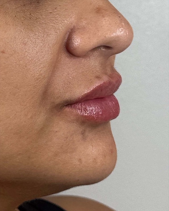 Juvederm Before & After