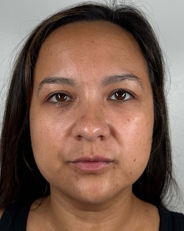 Juvederm Before & After