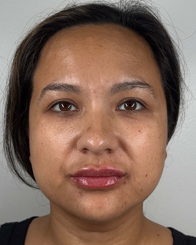 Juvederm Before & After