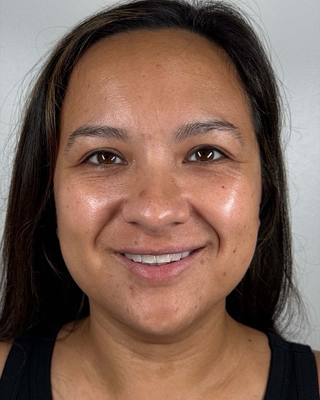 Juvederm Before & After