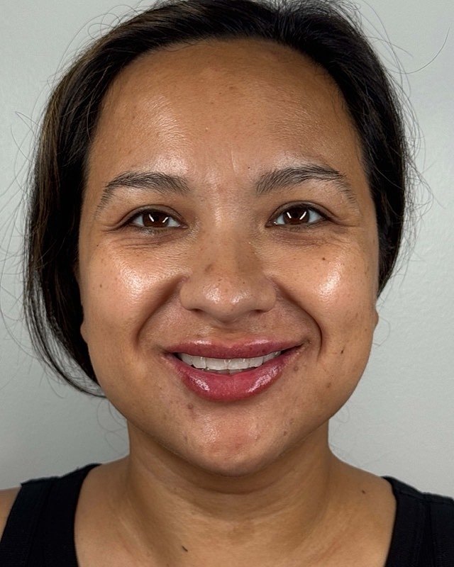 Juvederm Before & After