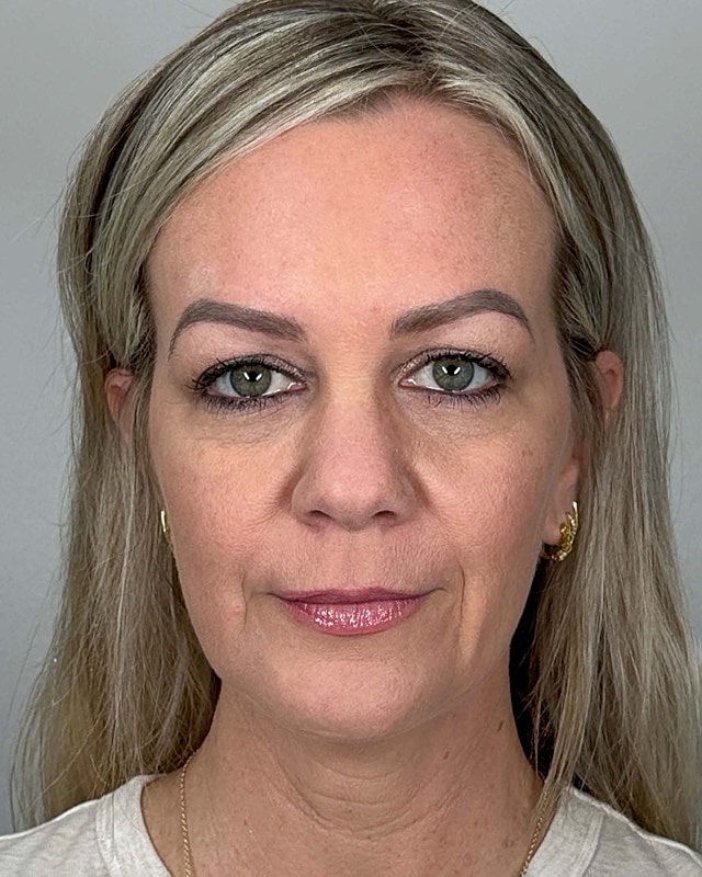 Juvederm Before & After