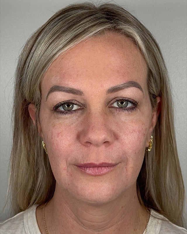 Juvederm Before & After