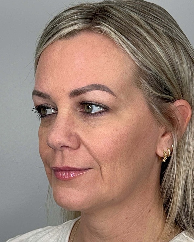 Juvederm Before & After
