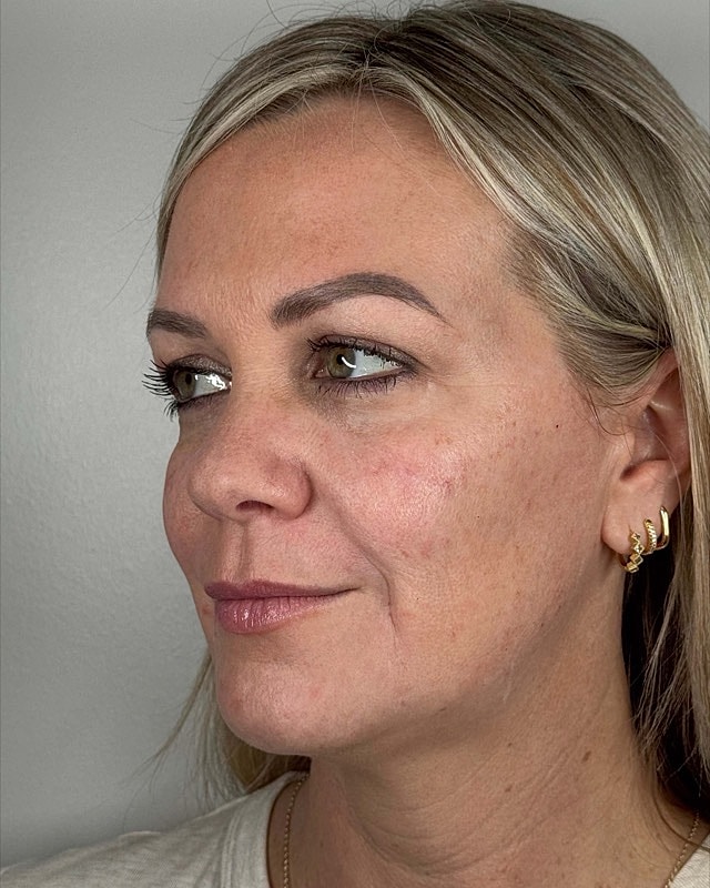 Juvederm Before & After