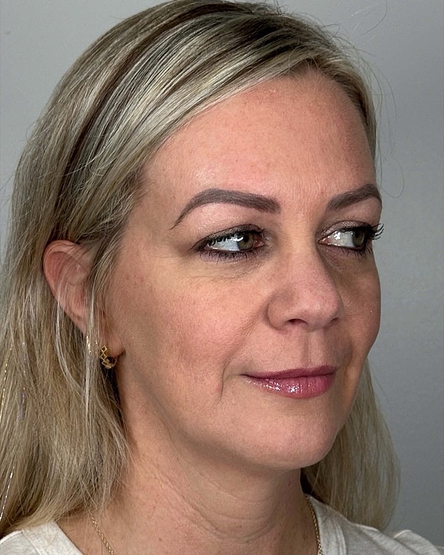 Juvederm Before & After