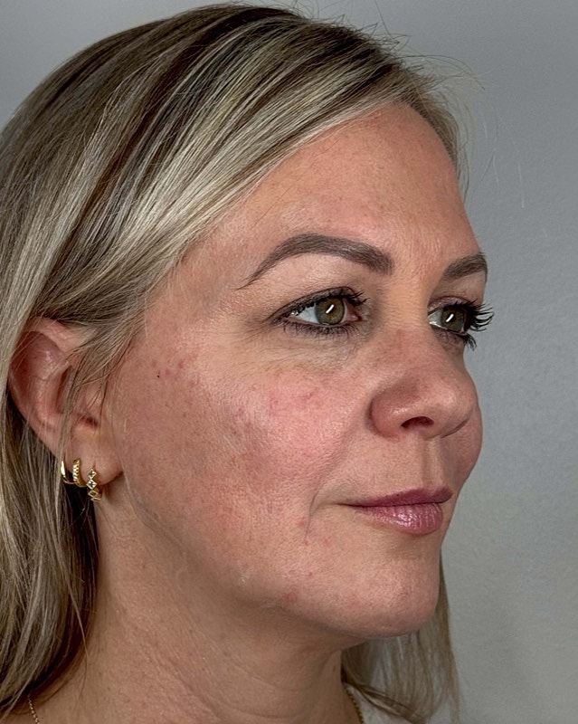 Juvederm Before & After