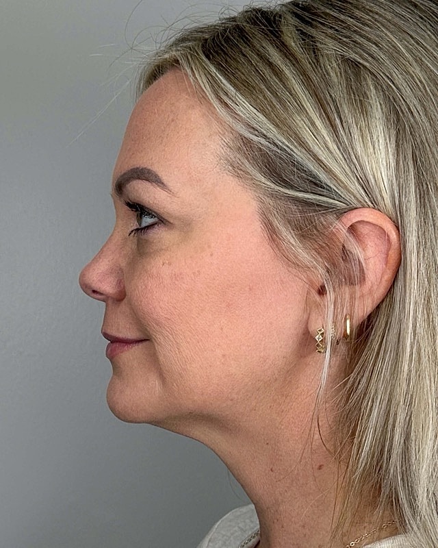Juvederm Before & After