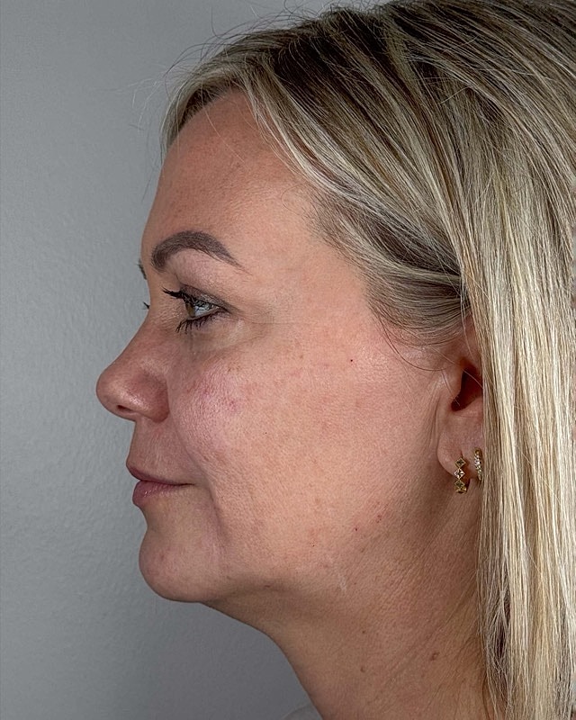 Juvederm Before & After