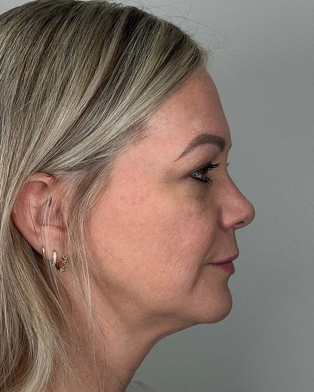 Juvederm Before & After