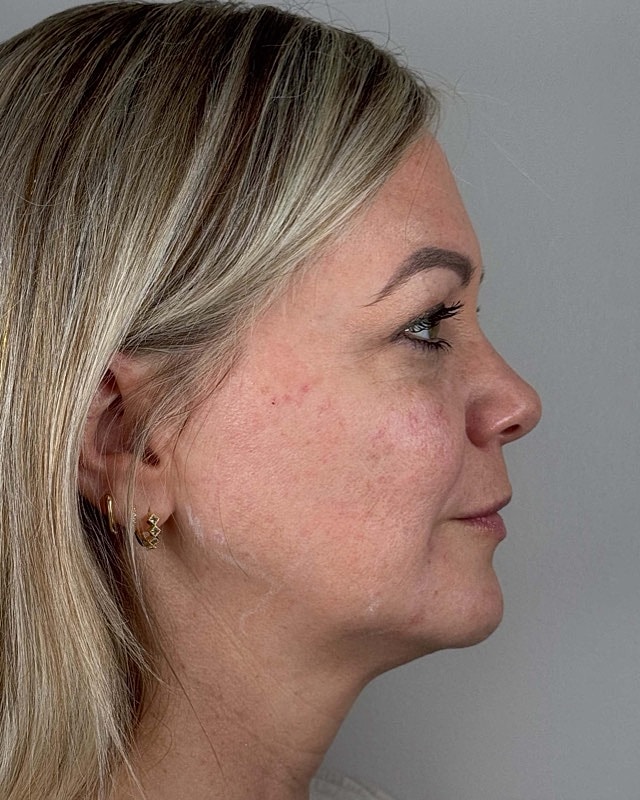 Juvederm Before & After