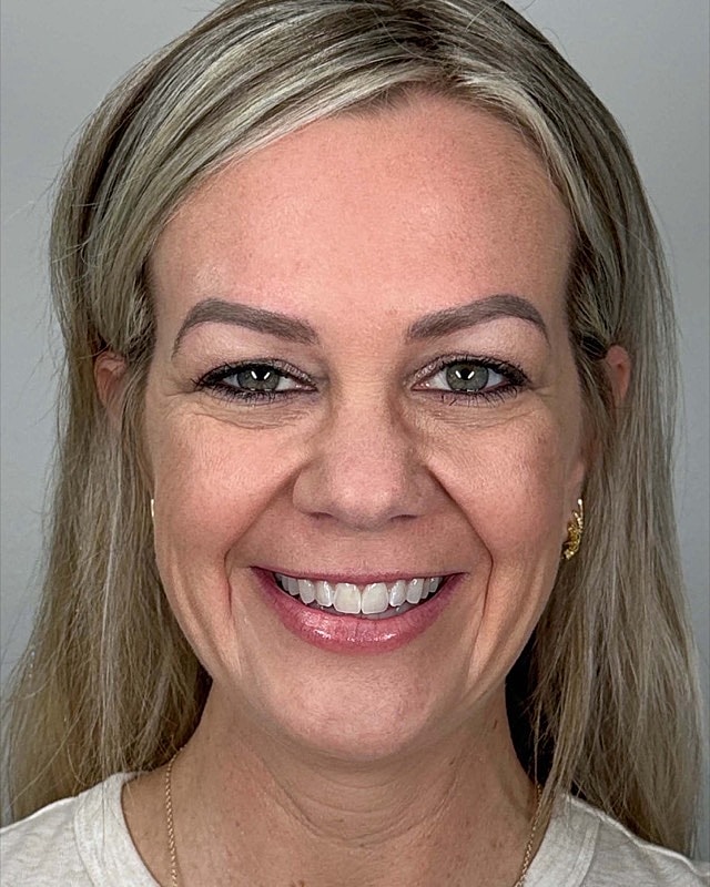 Juvederm Before & After